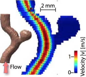 Aquired velocity field through a 3d-model of a generic aneurysm